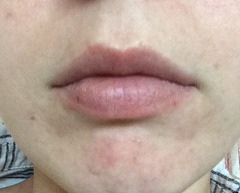 Lip enhancement.