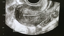 Diffuse thickening of cervical canal