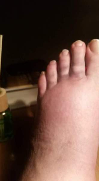 What have I done to my foot- very painful (picture)
