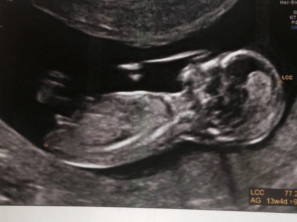 Any ideas on the sex of this baby please?