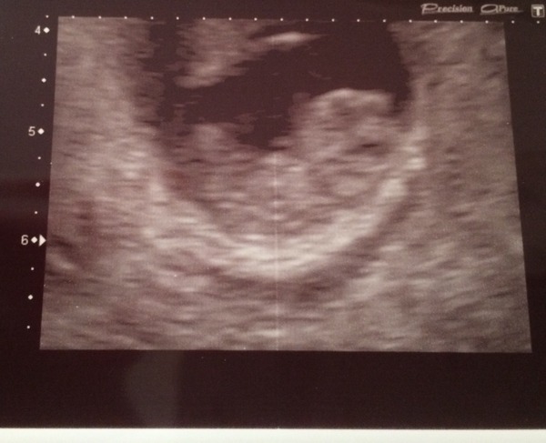 June 2016 #3, 12 week scans - Will you PLEASE hurry up?