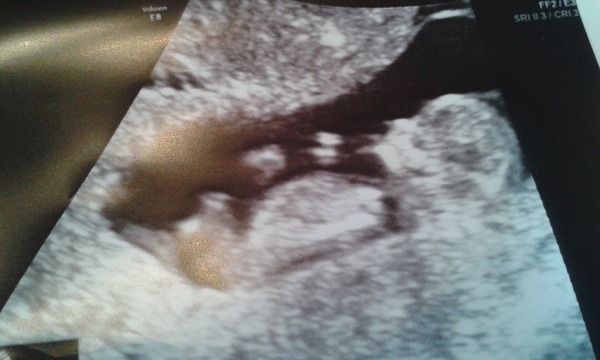 June 2016 #4 - 12 week scans, seeing tiny feet and hands!