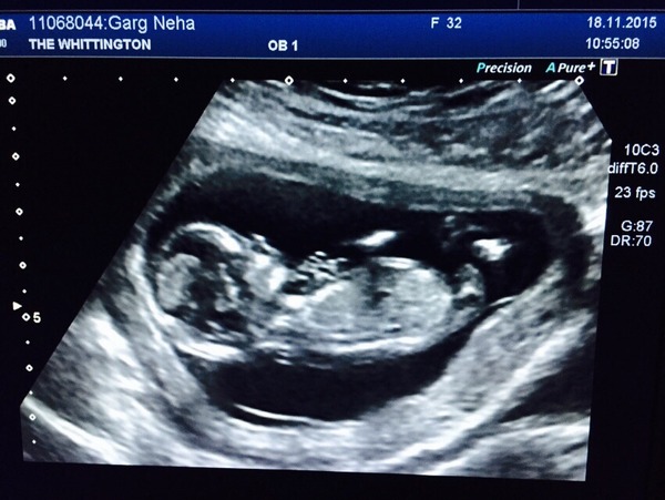 June 2016 #3, 12 week scans - Will you PLEASE hurry up?