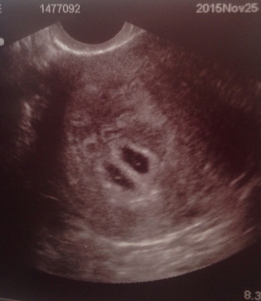 He wants me to have an abortion...