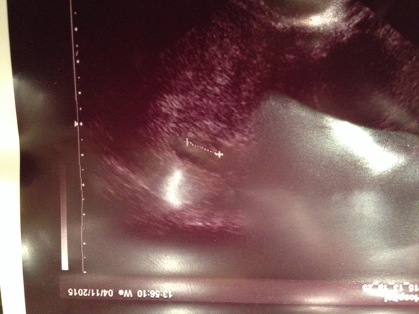 June 2016 #3, 12 week scans - Will you PLEASE hurry up?