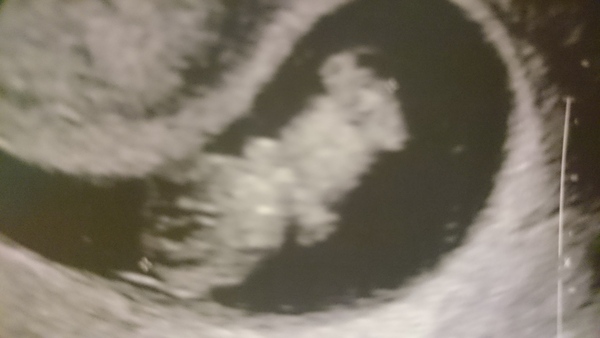 June 2016 #3, 12 week scans - Will you PLEASE hurry up?