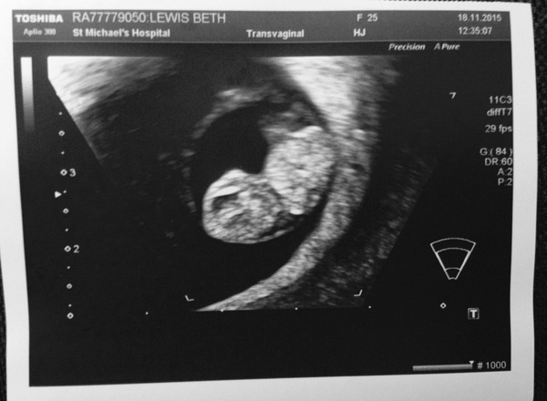 June 2016 #3, 12 week scans - Will you PLEASE hurry up?