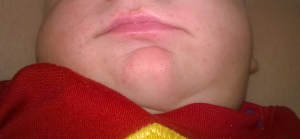 how do i treat the rash around my 5 week olds mouth??