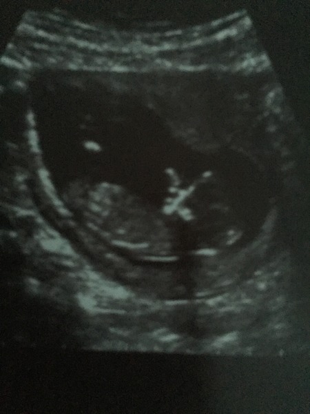 June 2016 #3, 12 week scans - Will you PLEASE hurry up?