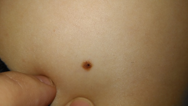 What could this be? Kids mole