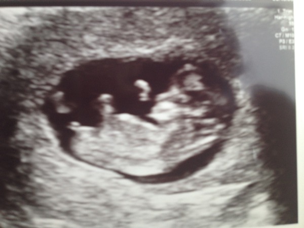 June 2016 #4 - 12 week scans, seeing tiny feet and hands!