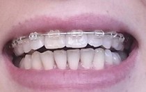 STILL not happy with teeth after braces!!