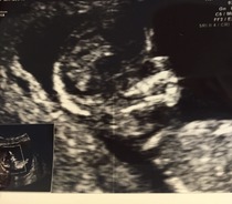 June 2016 #4 - 12 week scans, seeing tiny feet and hands!