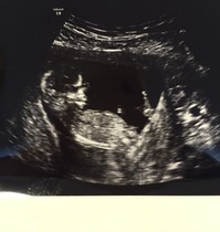 June 2016 #4 - 12 week scans, seeing tiny feet and hands!