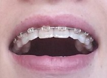 STILL not happy with teeth after braces!!