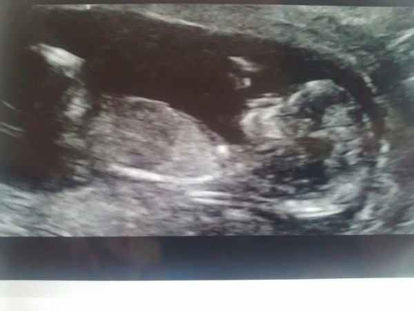 We're multitasking by crocheting and blood testing our way through pregnancy. We are waiting for our clutch of Christmas babies to hatch while our newbies are gearing up for scans, it's JS Grads 42!