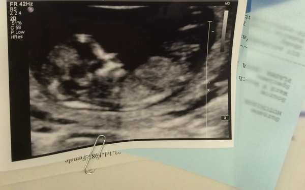 June 2016 thread #5 Starting the great gender speculation. ..