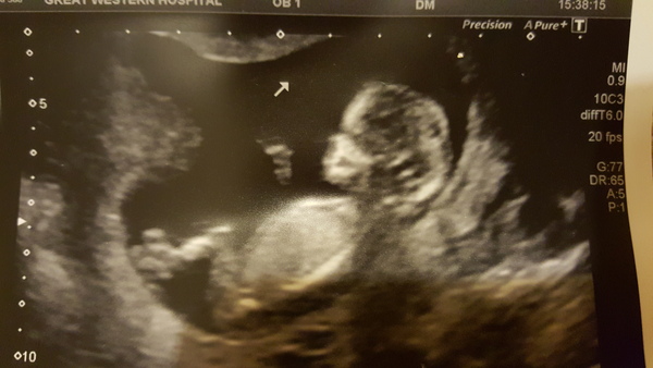 June 2016 thread #5 Starting the great gender speculation. ..