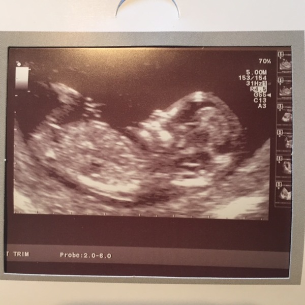 June 2016 #4 - 12 week scans, seeing tiny feet and hands!