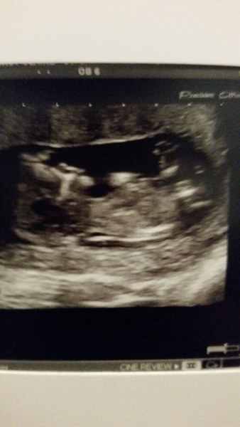 June 2016 #4 - 12 week scans, seeing tiny feet and hands!