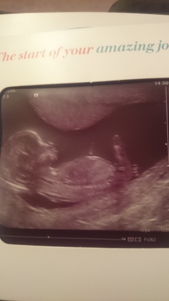 June 2016 thread #5 Starting the great gender speculation. ..