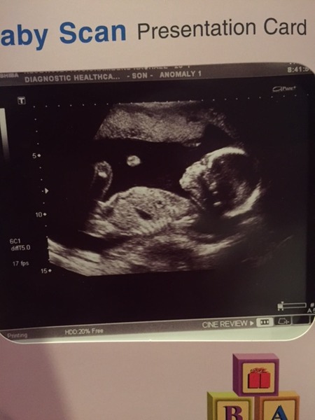 Is my 20 week scan normal