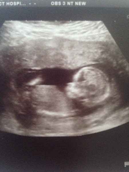 June 2016 #4 - 12 week scans, seeing tiny feet and hands!