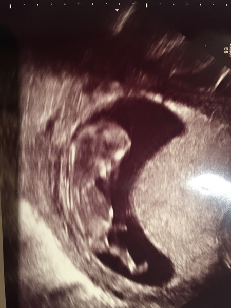 June 2016 #4 - 12 week scans, seeing tiny feet and hands!