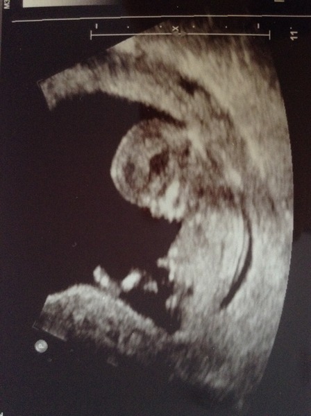 June 2016 #4 - 12 week scans, seeing tiny feet and hands!