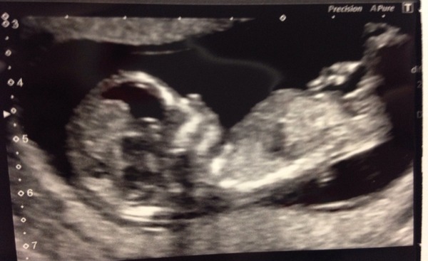 June 2016 thread #5 Starting the great gender speculation. ..