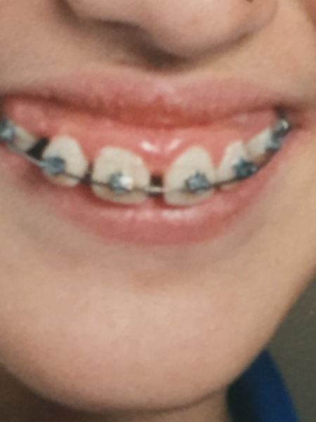 AIBU to want dd to have traintrack braces but no teeth removed?