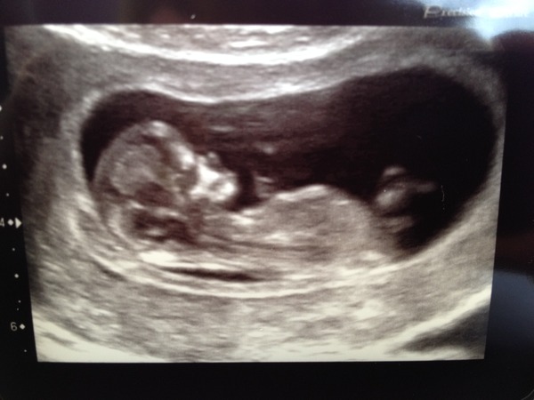 June 2016 #4 - 12 week scans, seeing tiny feet and hands!