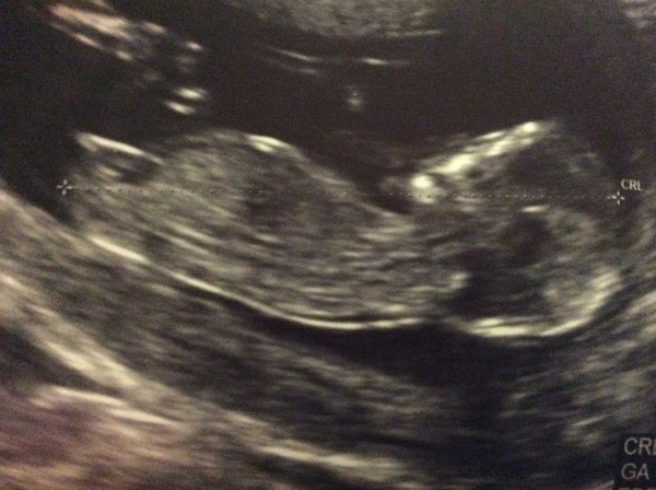 Can you tell sex of baby at 13 weeks