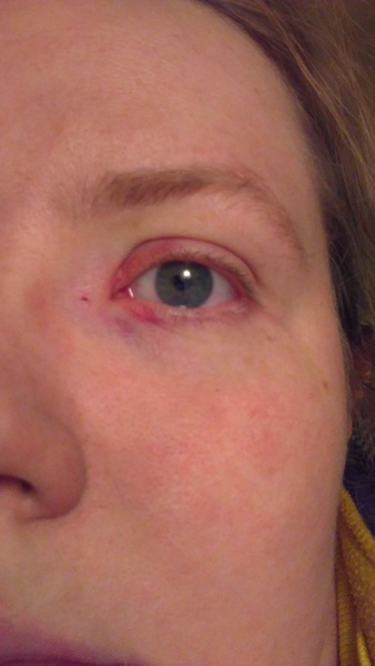 Ouch, cat claw through eyelid!