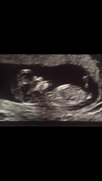 Boy or Girl?