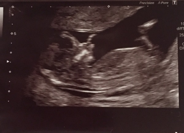 June 2016 thread #5 Starting the great gender speculation. ..