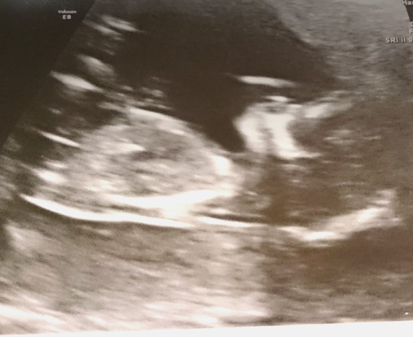 June 2016 #4 - 12 week scans, seeing tiny feet and hands!