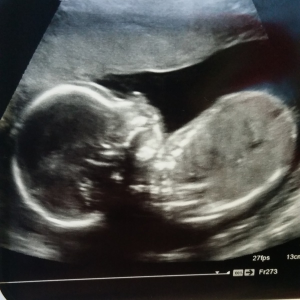 April 2016 babies - 20-week scans, growing bumps and little kicks!