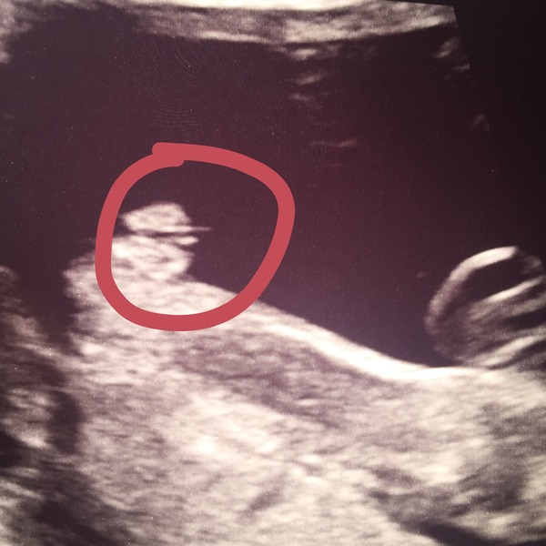Had 3 scans and disagreement about the sex!