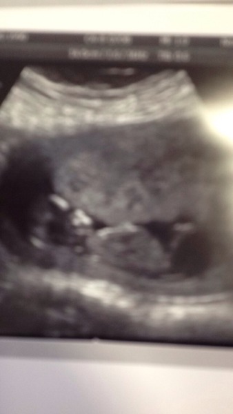 June 2016 thread #5 Starting the great gender speculation. ..