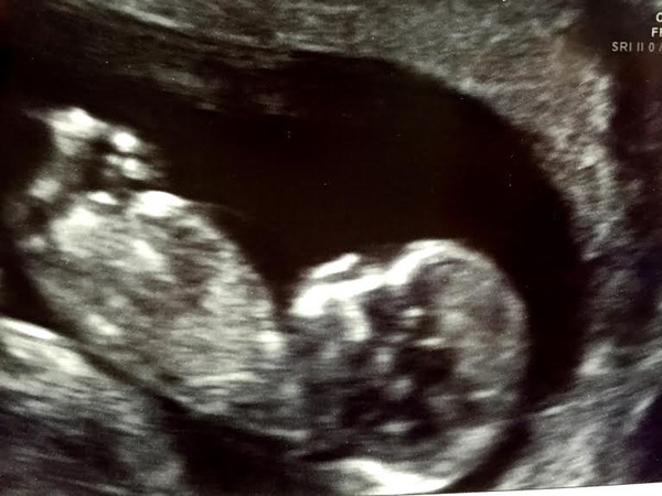 June 2016 #4 - 12 week scans, seeing tiny feet and hands!