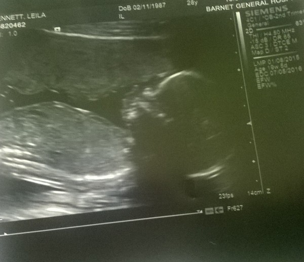 Staying posifrickentive - Thread 7 for ladies pregnant after mc