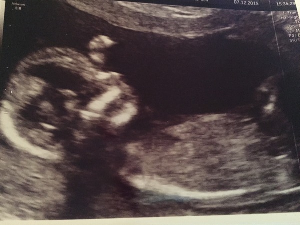 June 2016 #4 - 12 week scans, seeing tiny feet and hands!