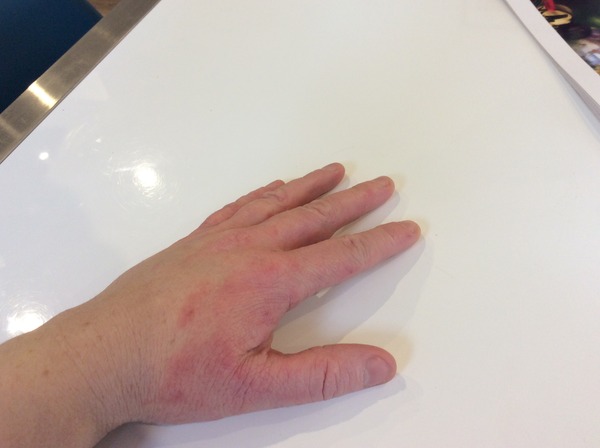 Hand Eczema and Working