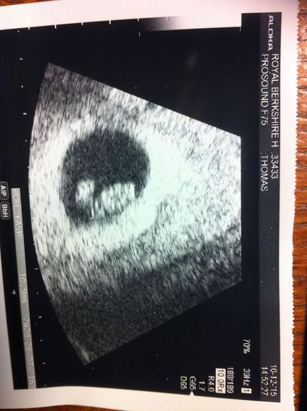 Viability scan tomorrow, HbAc1 levels too high at conception worried.