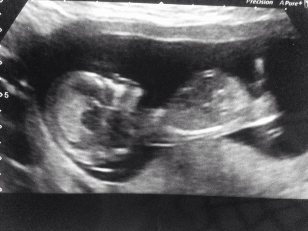 June 2016 thread #5 Starting the great gender speculation. ..