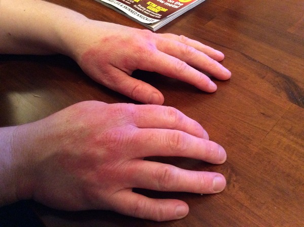 Hand Eczema and Working