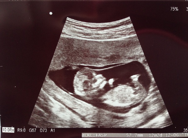 June 2016 #4 - 12 week scans, seeing tiny feet and hands!