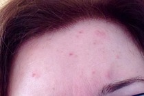 Sick of hormonal teenage skin :(