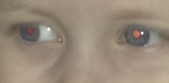 Red eye reflex